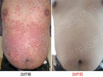 牛皮癣偏方治疗原则