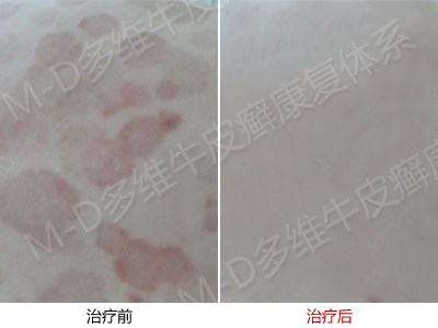 寻常型牛皮癣是应该如何预防呢