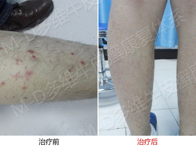 患者得了牛皮癣如何调节心理