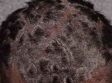 头部牛皮癣患者怎样预防脱发