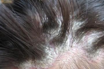 牛皮癣患者脱发是什么原因