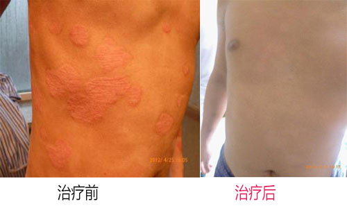 牛皮癣的发病病因有哪些
