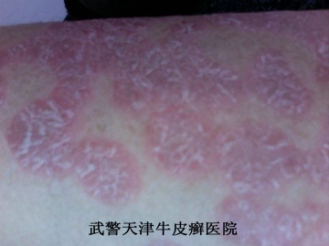 皮肤长了红斑是牛皮癣吗