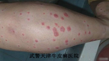 什么原因造成了牛皮癣