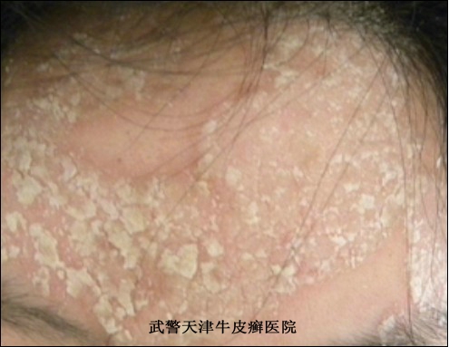 怎么预防牛皮癣复发