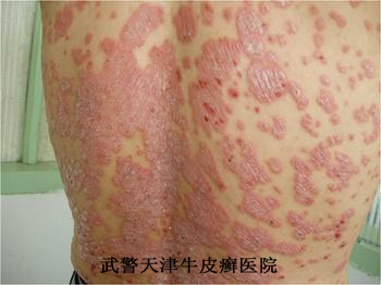常见的预防牛皮癣的方法是什么