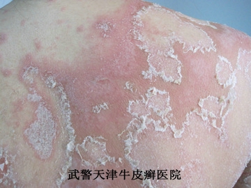 该如何做好牛皮癣的预防工作