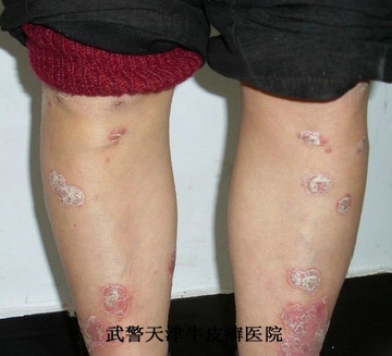 寻常型牛皮癣如何诊断