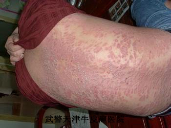 牛皮癣的病因在哪些方面