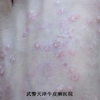 牛皮癣患者该怎么补水
