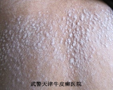 牛皮癣在进行期要如何进行诊断