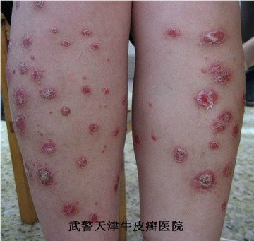 中年牛皮癣患者如何预防