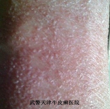牛皮癣心理调节方法有哪些