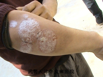 牛皮癣不能根治的原因是什么