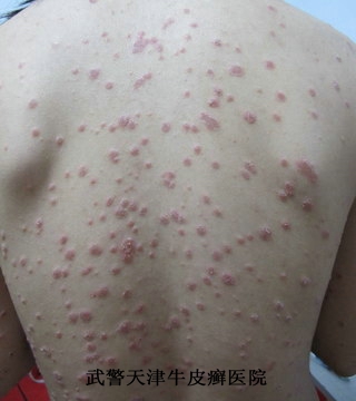 科学的治疗牛皮癣最好方法