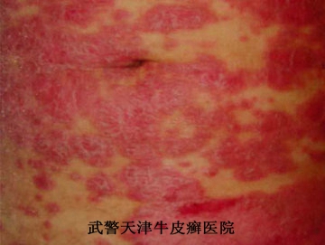 牛皮癣都有哪些防治方法