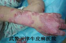 牛皮癣患者的心理怎么调节