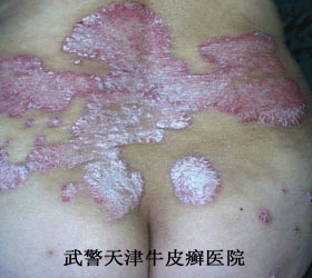 生活中牛皮癣患者如何保健