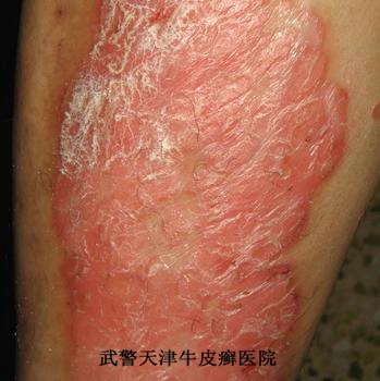 牛皮癣在消退期应注意些什么